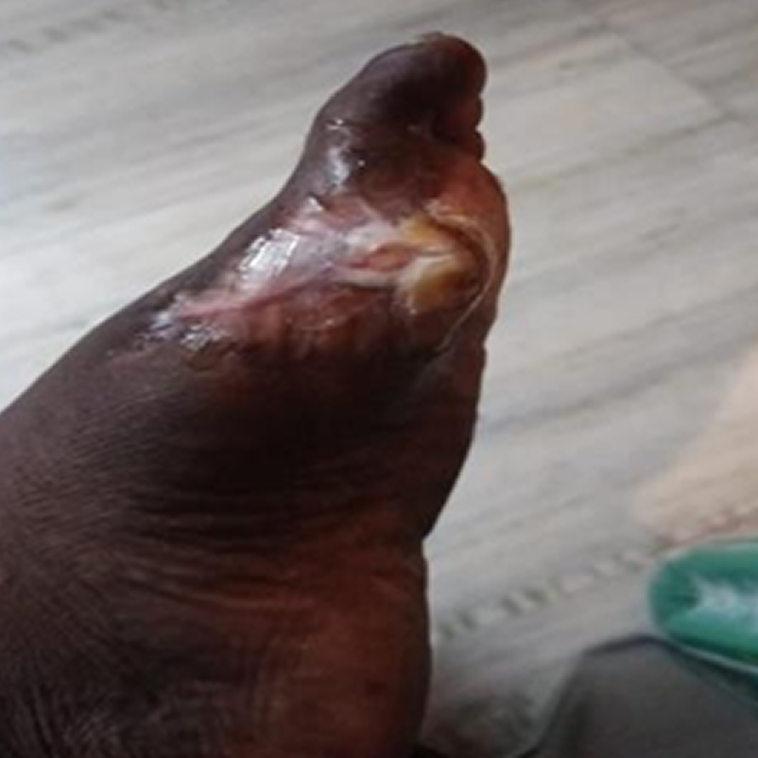 Accelerated Tissue Regeneration in Post-Amputation Wound