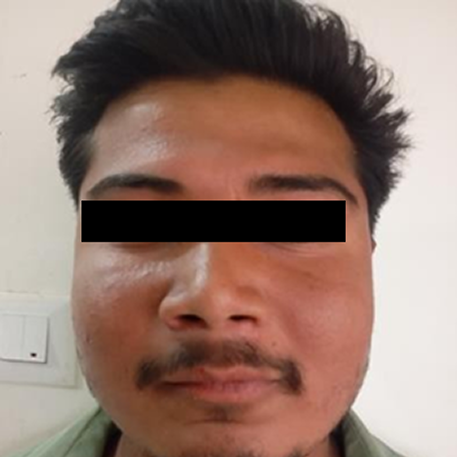 Effective Management of Superficial to Partial-Thickness Thermal Burn